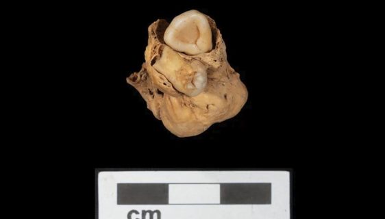 در فسیل 3000 ساله یک زن مصری، توموری با دو دندان کشف شد! + عکس