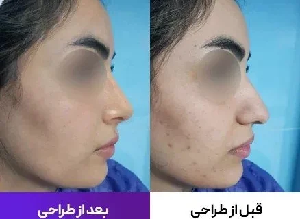 شبیه‌سازی عمل بینی با هوش مصنوعی
