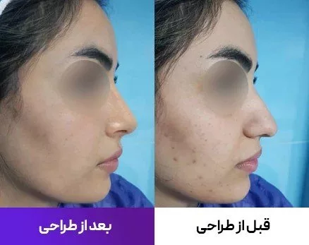 شبیه‌سازی عمل بینی با هوش مصنوعی